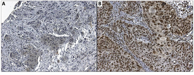 Microphotography of A. Cytoplasmic expression of CD274 in a positive case, and B. Nuclear expression of HOXB9 in a positive case.