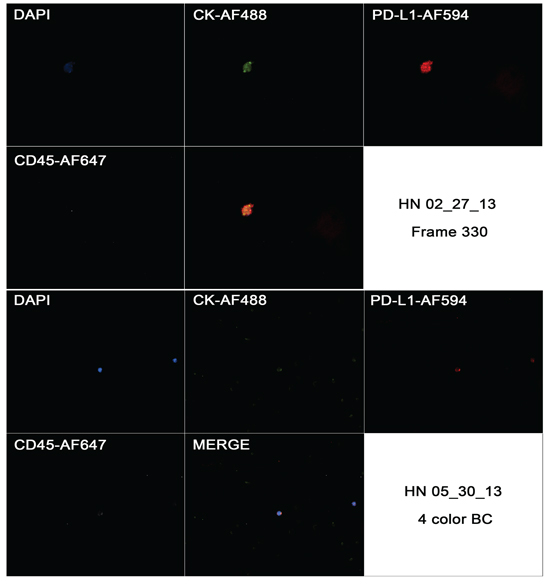 Captured images from a CTC in a HNSCC case (HN 02/27/13) showing positivity to CK, negativity for CD45 and strong and focal positivity to CD274 in first image (frame 330), and the same markers in a blood cell from a different case (HN 05/30/13).
