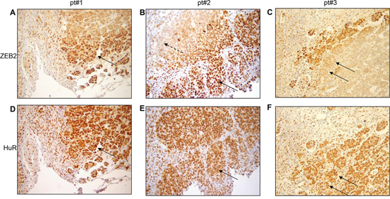 In tumor edge nuclear ZEB2 co-localizes with cytoplasmic HuR.