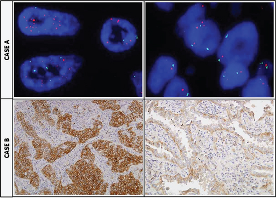 Tumor heterogeneity regarding MET status.