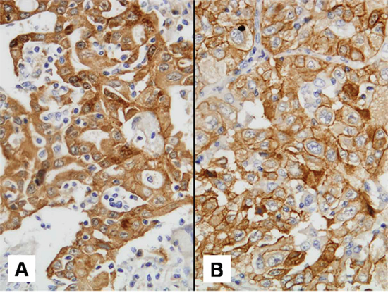 Met IHC staining pattern discordance.