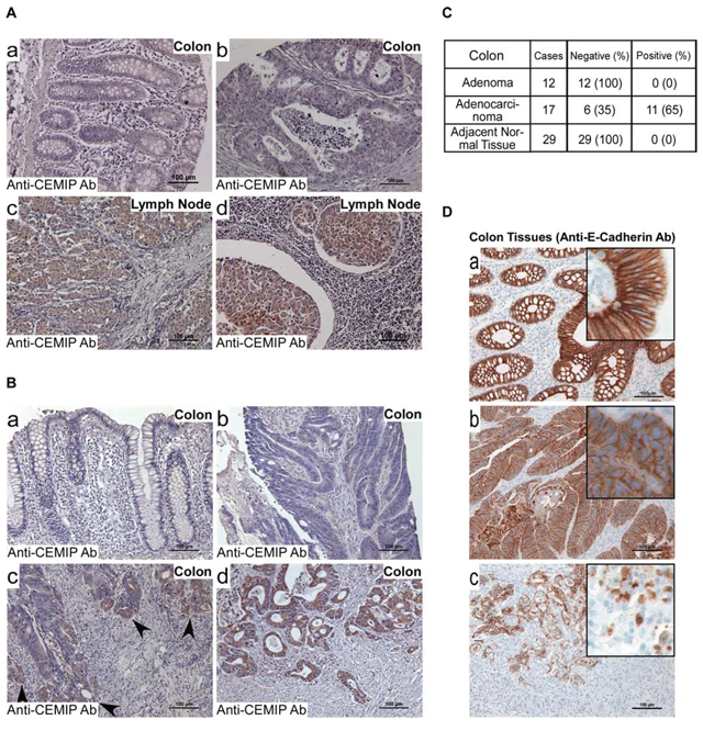Upregulation of CEMIP in human invasive and metastatic colon cancer.