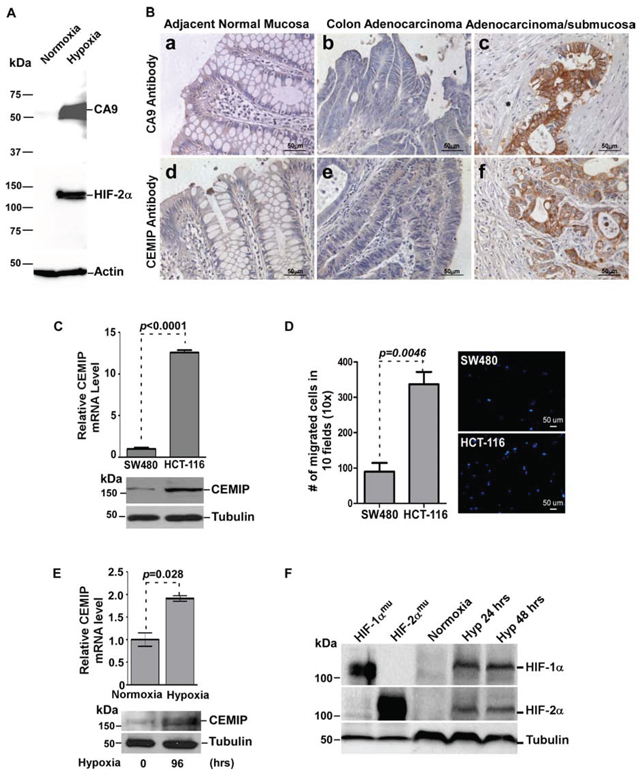 Hypoxia induces CEMIP expression in human colon cancer.