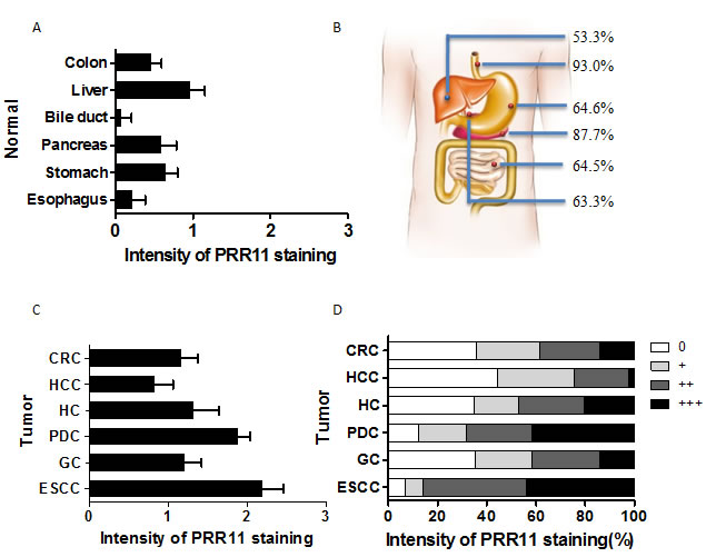 Expression patterns of PRR11 protein in 6 human gastrointestinal tissues and tumors.