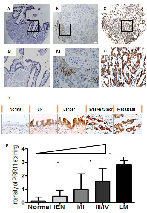 Expression profiles of PRR11 in hilar cholangiocarcinoma.