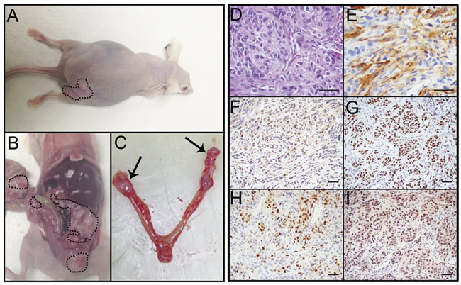 PTENshRNA MOE form high-grade carcinoma