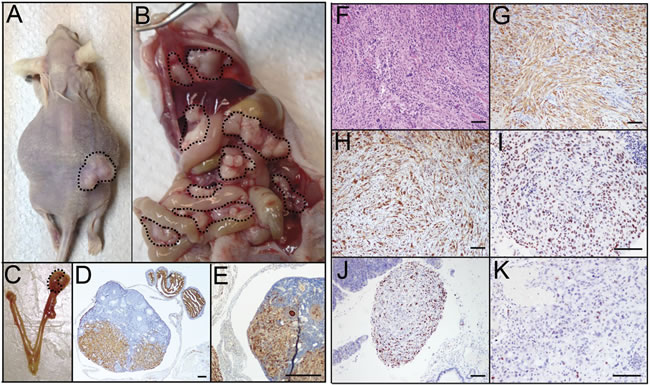 PTENshRNA/KRASG12V MOE give rise to highly-aggressive carcinomas with advanced i.p.