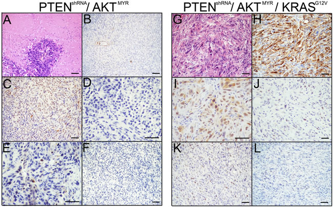 MOE with AKTMYR had reduced tumor phenotypes.