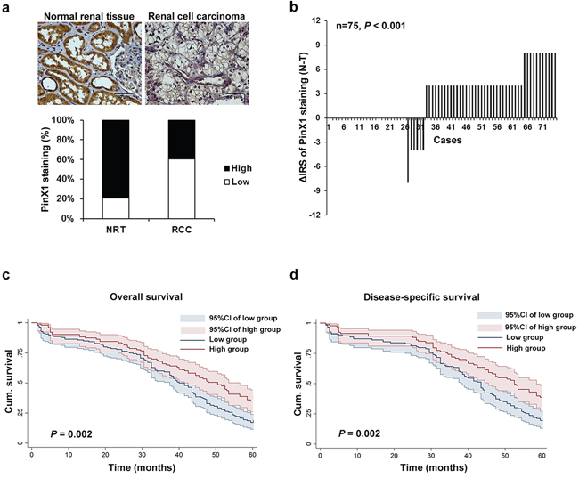 Expression of PinX1 is decreased in ccRCC tissues and associated with 5-year overall and disease-specific survival in ccRCC patients.