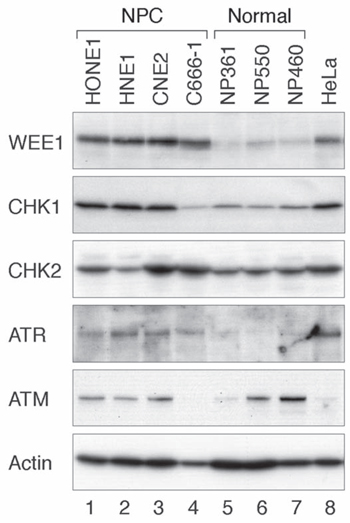The ATR-CHK1-WEE1 axis is overexpressed in NPC cell lines.