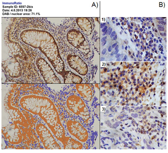 Image analysis for GSTO1 in tissue.