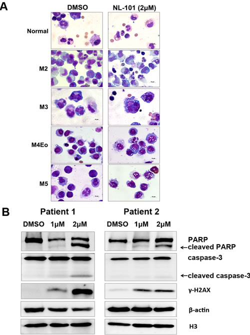 NL-101 triggers apoptosis of leukemia cells from AML patients.