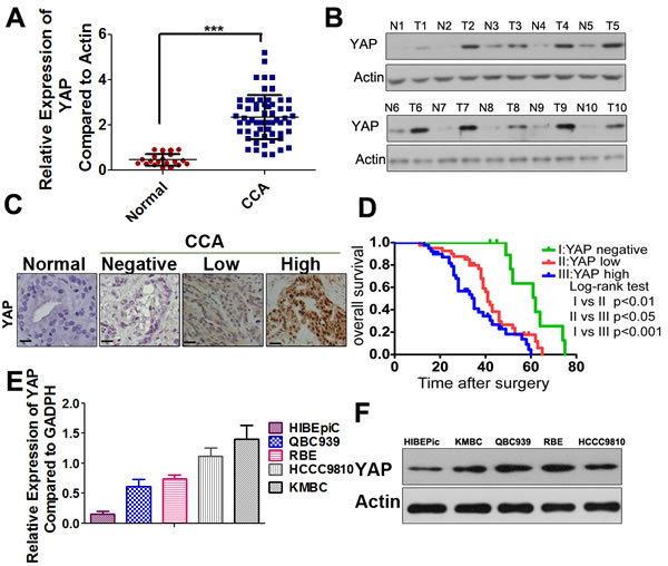 YAP is highly expressed in CCAs and predicts a poor prognosis.