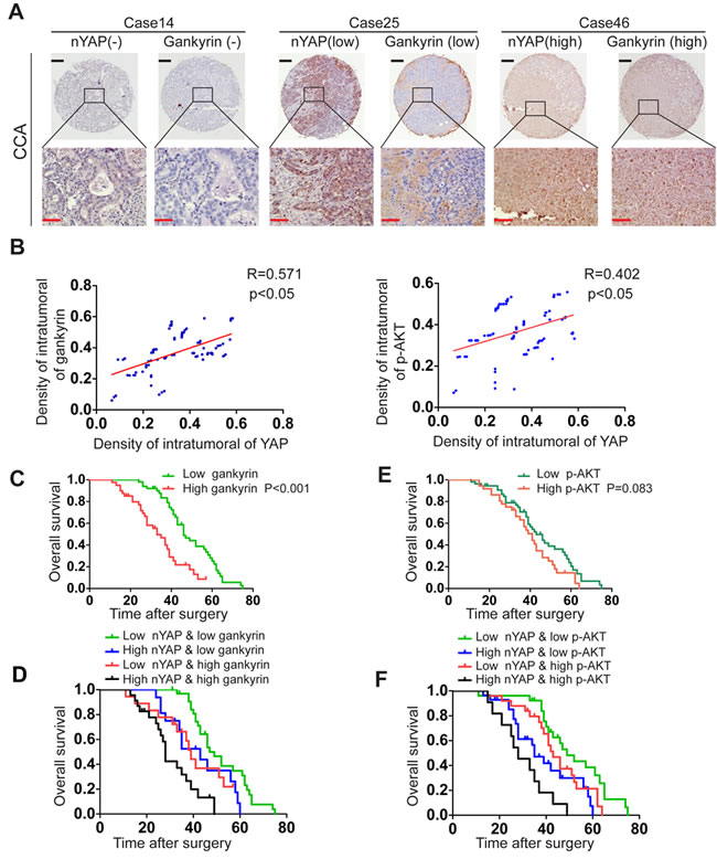 Combination of nYAP and gankyrin or p-AKT improves prognostic accuracy for CCA patients.