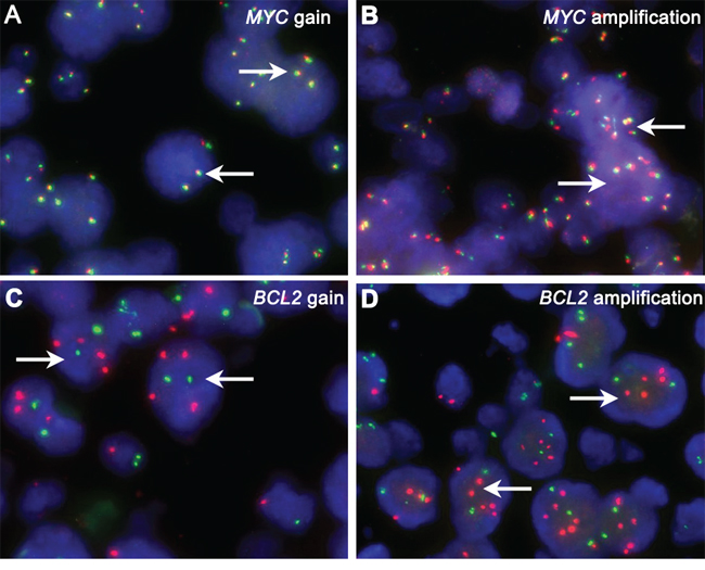 CNA of MYC and BCL2.