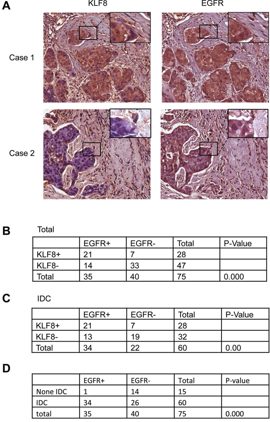 Correlated upregulation of KLF8 and EGFR expression in human breast cancer patient tumors.