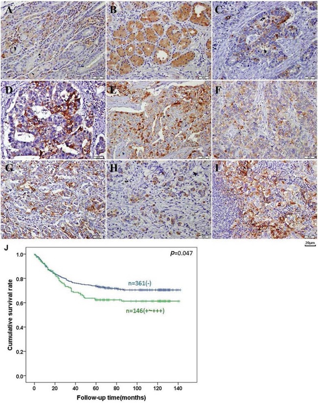 BTG1 expression and prognostic significance in gastric cancer.
