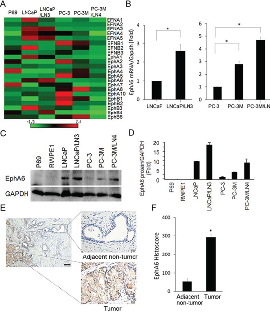 EphA6 mRNA and protein expression is up-regulated in CaP lymph node metastatic cell lines and CaP tumor tissues.