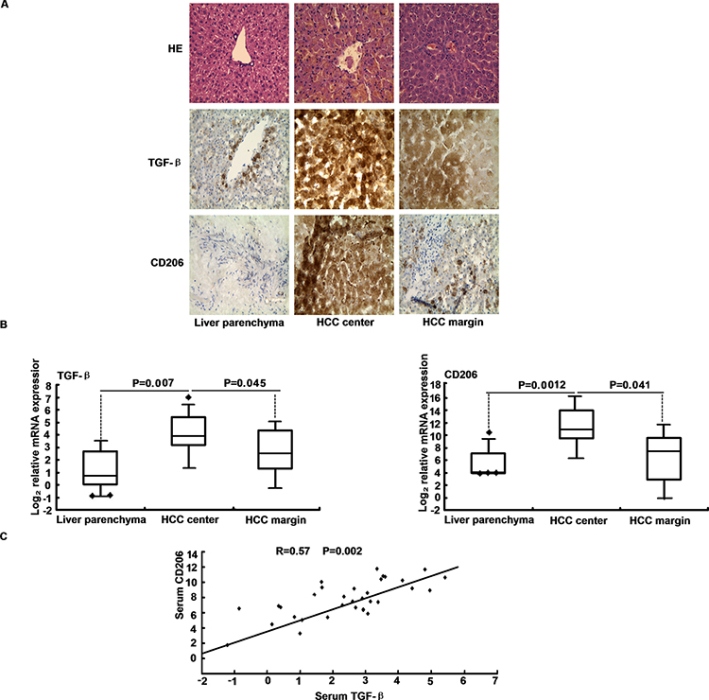 TGF-&#x03B2; levels correlate with macrophage marker expression in HCC.