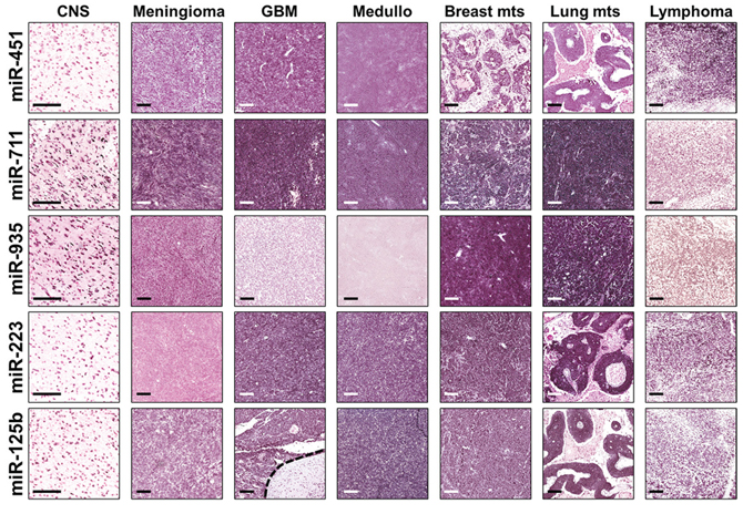 Representative ISH evaluation of miR-125b, miR-223, miR-451, miR-711, miR-935 in tissue sections of primary and metastatic CNS tumors.