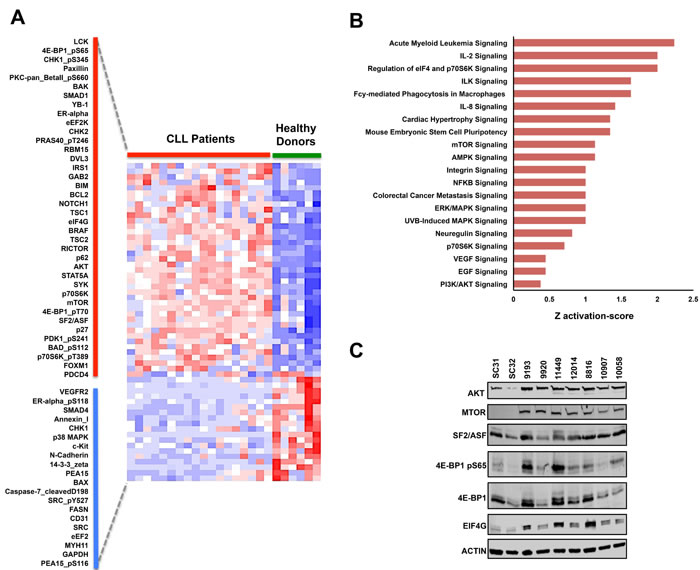 Supervised RPPA analysis reveals potential oncoproteins in CLL.