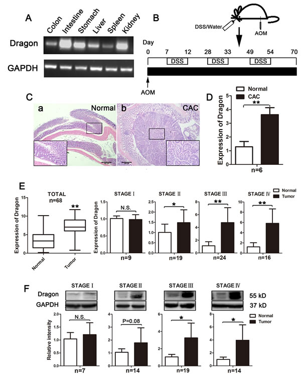 Expression of Dragon in normal colons and colorectal cancer tissues in mice and in human patients.