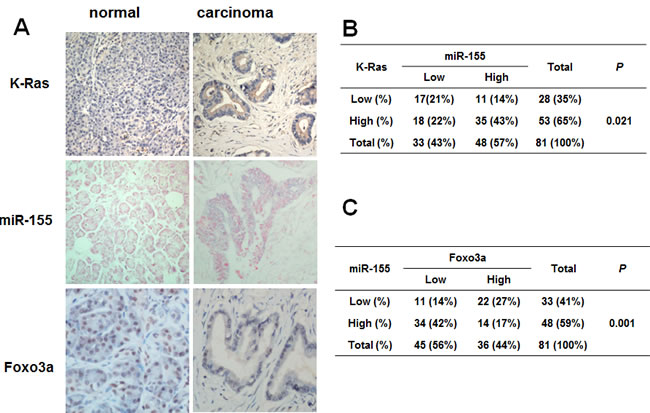 Correlation of K-Ras, miR-155 and Foxo3a expression in human pancreatic cancer tissues.