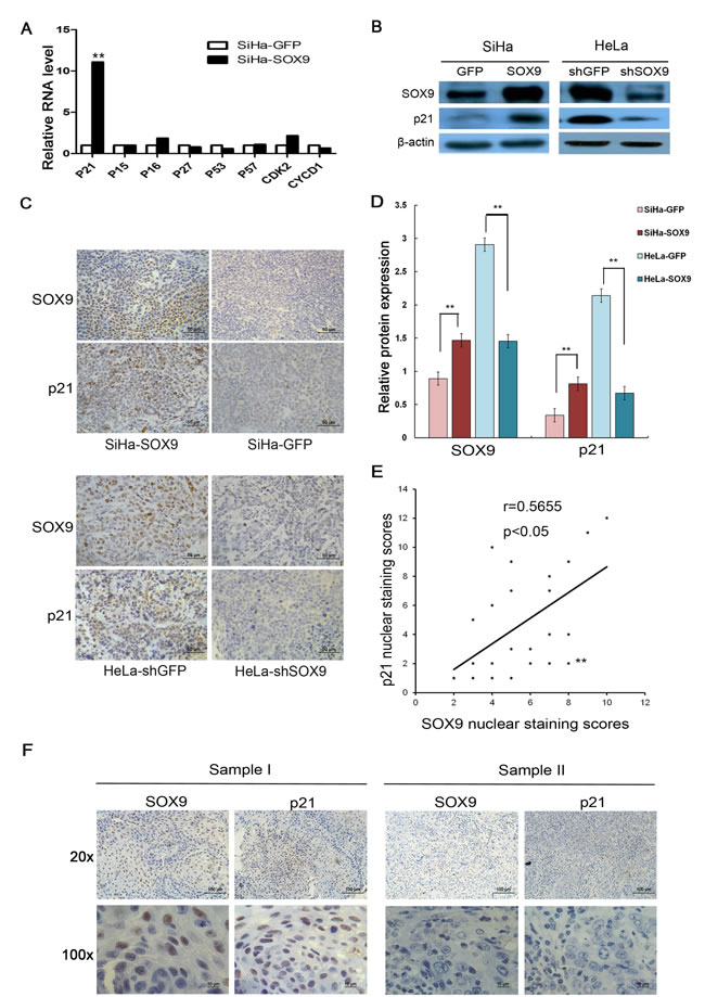 SOX9 transactivated p21 expression in cervical cancer cells and in cervical carcinoma tissues of patients.