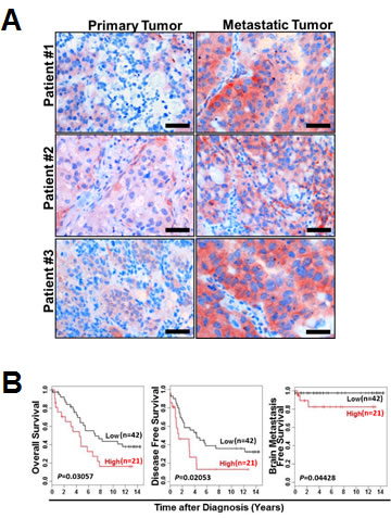 AF1q expression in breast cancer is positively associated with metastasis.