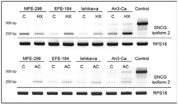 Expression of SNCG isoform 2 in EC cell lines MFE-296, EFE-184, Ishikawa, and An3-Ca under (C) control conditions, (HX) hypoxia (18 hrs, O2 > 1%) or (AC) acidosis (18 hrs, pH 6.2).
