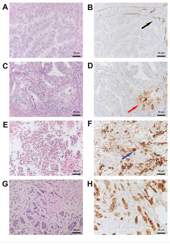 Immunohistochemical detection of SNCG protein in endometrial and breast cancer tissue.
