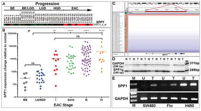 Transcriptional upregulation of SPP1/OPN is a frequent event in EAC patients.
