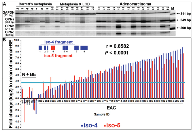Co-overexpression of all five OPN isoforms in individual primary EACs.