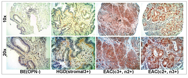 Overexpression of OPN protein in EAC using tissue microarray (TMA) immunohistochemistry.