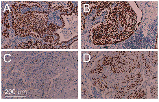 Intratumoral heterogeneity of TP53 mutations.