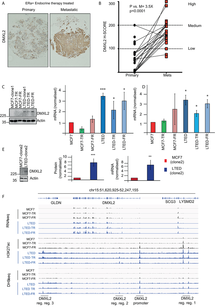 DMXL2 is overexpressed in metastatic tumors resistant to endocrine therapy.