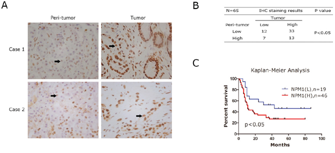 Immunohistochemistray results of NPM1 in PDAC specimens.