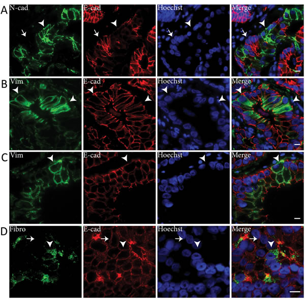 E-cadherin is downregulated in N-cadherin positive tumor cell clusters in clinical PCa.