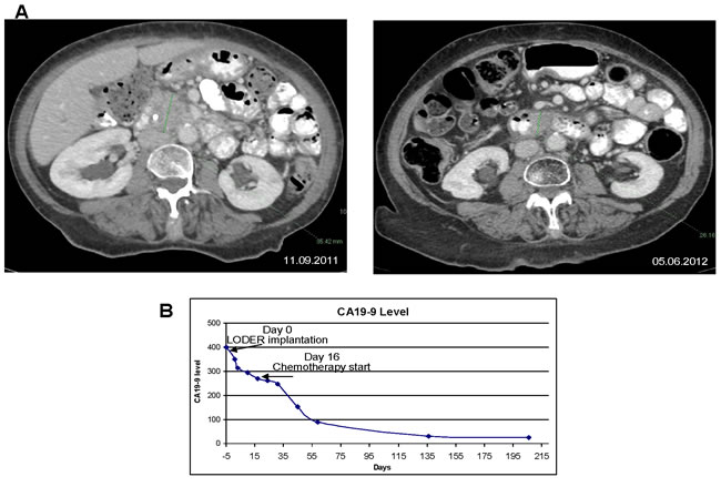 Anti-tumor effect of combination treatment with