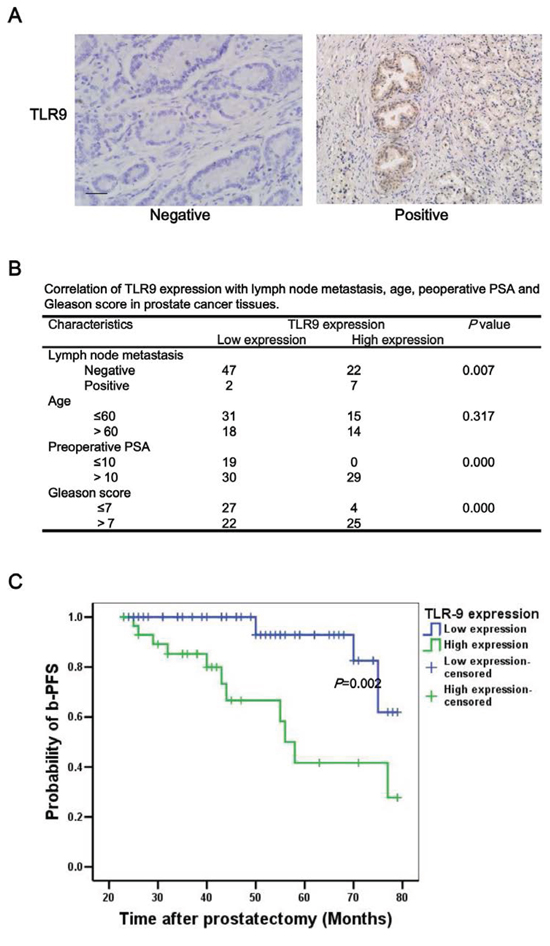 High expression of TLR9 was correlated with a higher probability of lymph node metastasis and poor prognosis of patients with prostate cancer.