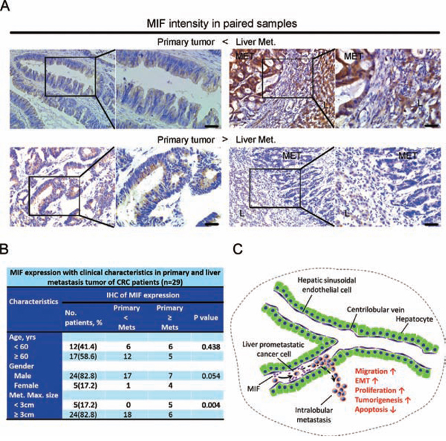 Analysis of tumors in patients with CRC and a proposed model of secreted MIF-mediated chemotraction of CRC cells in the liver sinusoids.