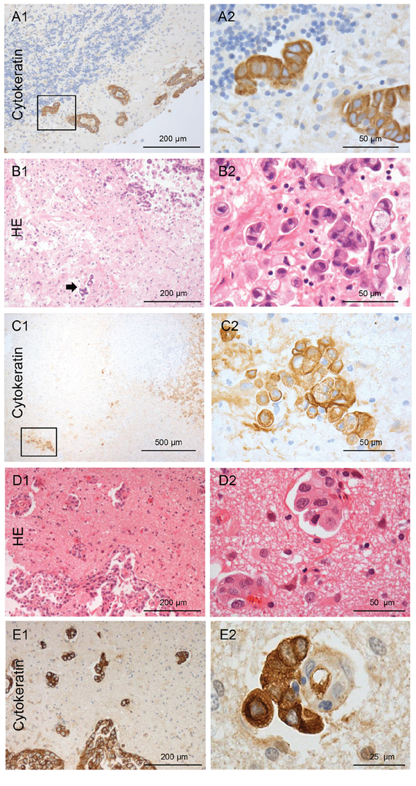 Types of NSCLC carcinoma infiltration.