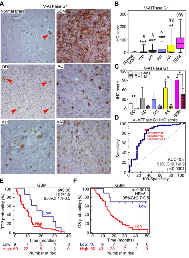 V-ATPase subunit G1 is a novel marker of poor prognosis in GBM patients.