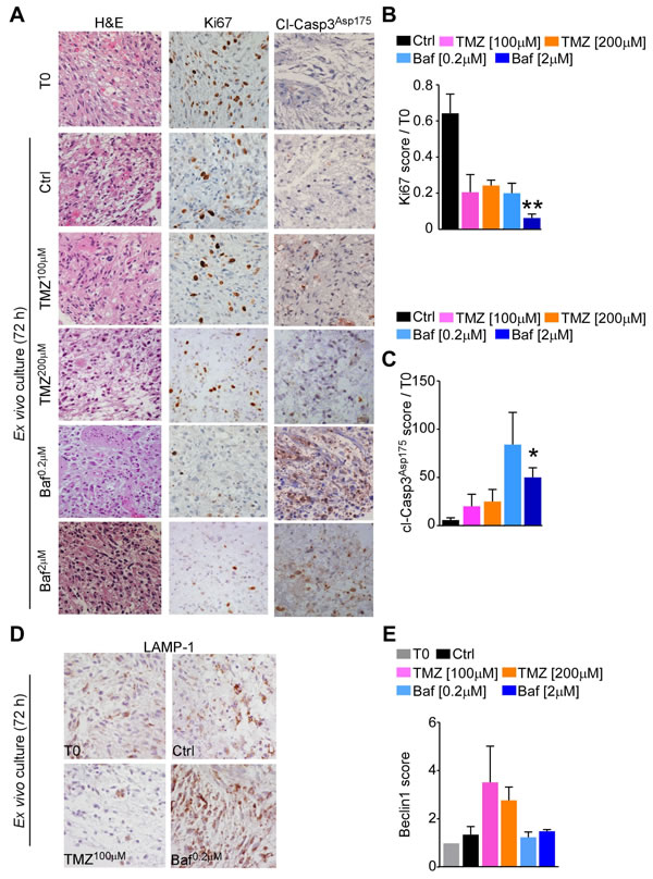 Bafilomycin A1 treatment decreases cell viability in GBM tissue cultures.