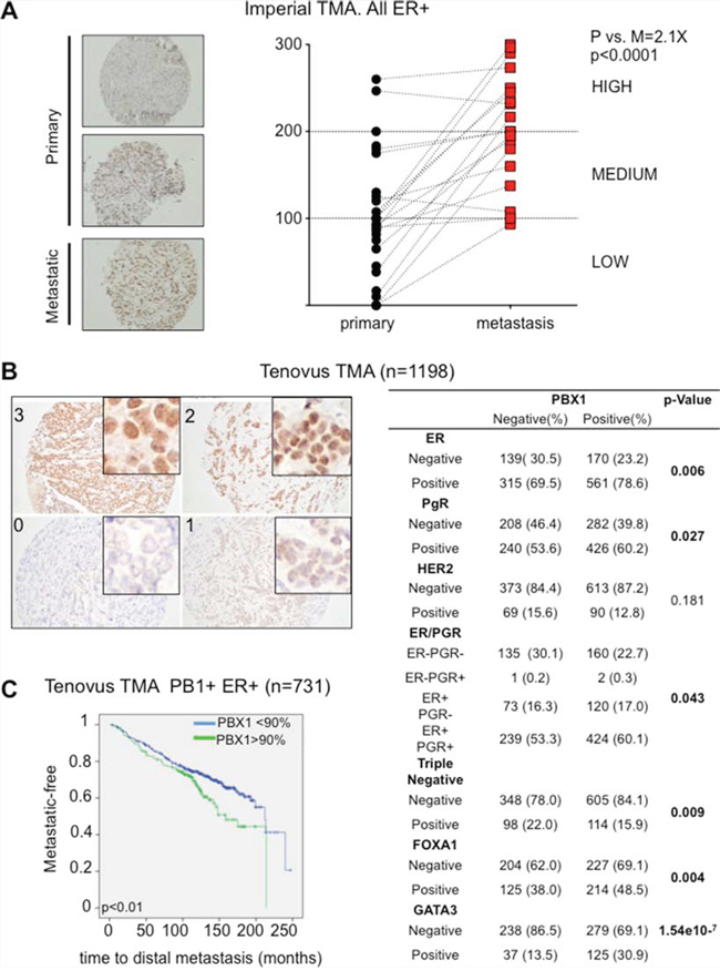 PBX1 is a novel prognostic biomarker for ER&#x03B1; breast cancer.