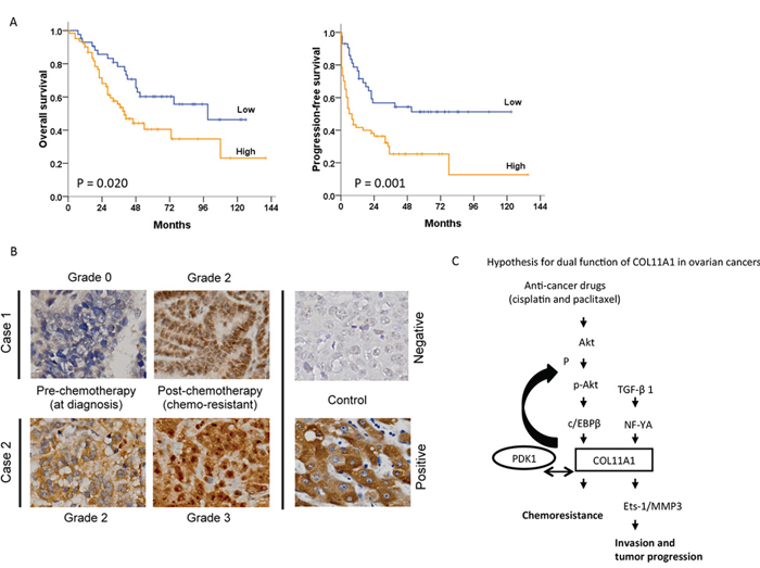 Association between COL11A1 expression and patient outcomes in ovarian cancer.
