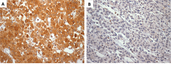 A. Strong imunoreactivity (score 6) for DICER1 in a virilizing ACC in a 59-yr-old woman presenting a favorable outcome after 97 months of follow-up (400x). B. Metastatic ACC in a 30-yr-old man displaying a negative immunoreactivity (score 0) for DICER1 (400x). ACC, adrenocortical carcinoma.