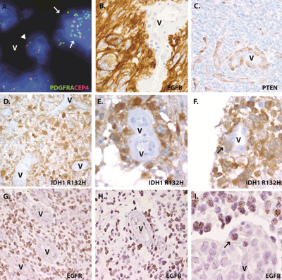 Glioma specific molecular alterations are not a common feature of endothelial tumor vasculature in clinical samples.
