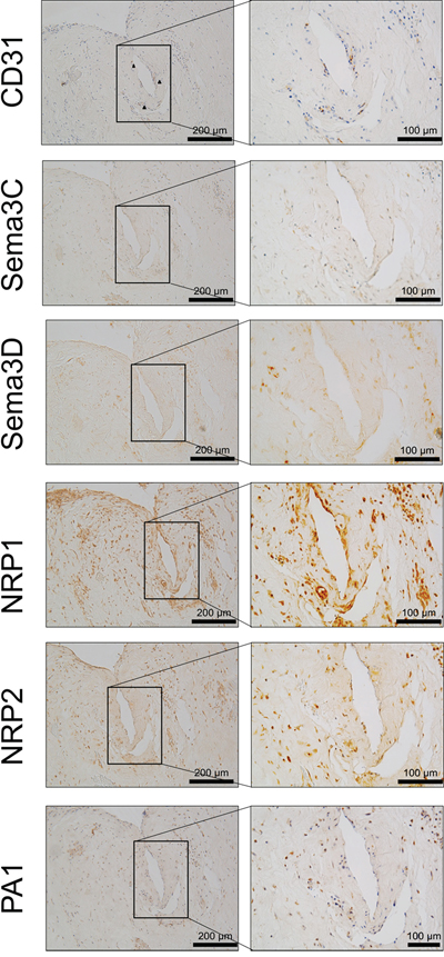 Co-localisation of CD31 and sema3C, sema3D and receptors NRP1, NRP2 and PA1 immunopositivity within human IVD tissue.