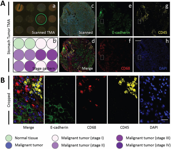 E-cadherin/CD68/CD45 triple staining of stomach TMA.